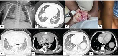 Genetically confirmed chronic granulomatous disease in a Kenyan child: case report